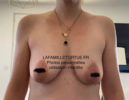 Lipofilling mammaire - Avant 2 - La Famille Tortue